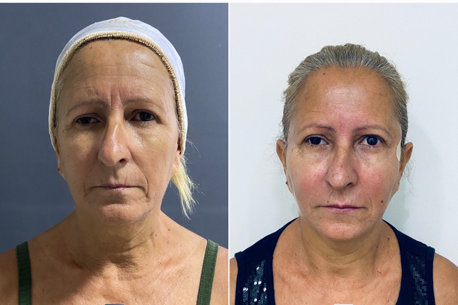 Antes e depois de harmonização facial