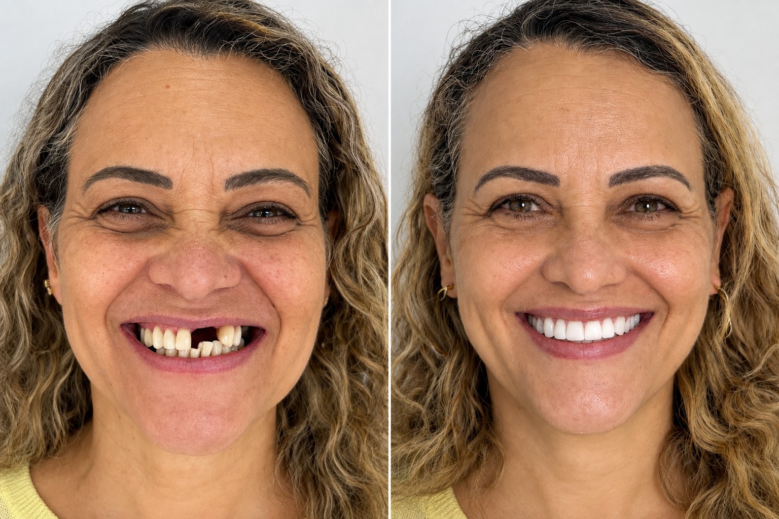 Antes e depois de reabilitação com implante dentário