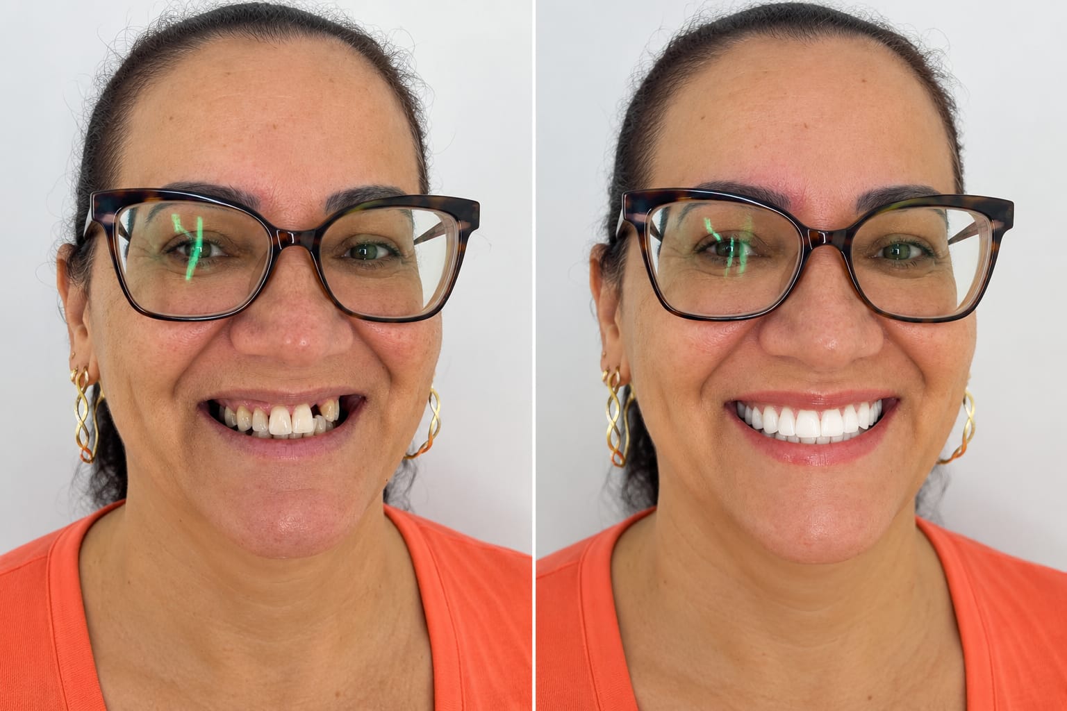 Caso de implante dentário tratado na Vem Sorrir Odontologia em Anchieta